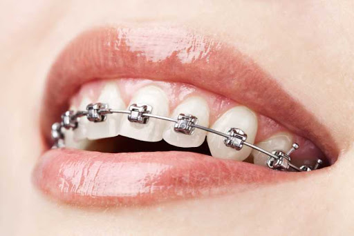 จัดฟันแบบไม่ใส่ยางจัดฟัน – Bkk-Dental.Com