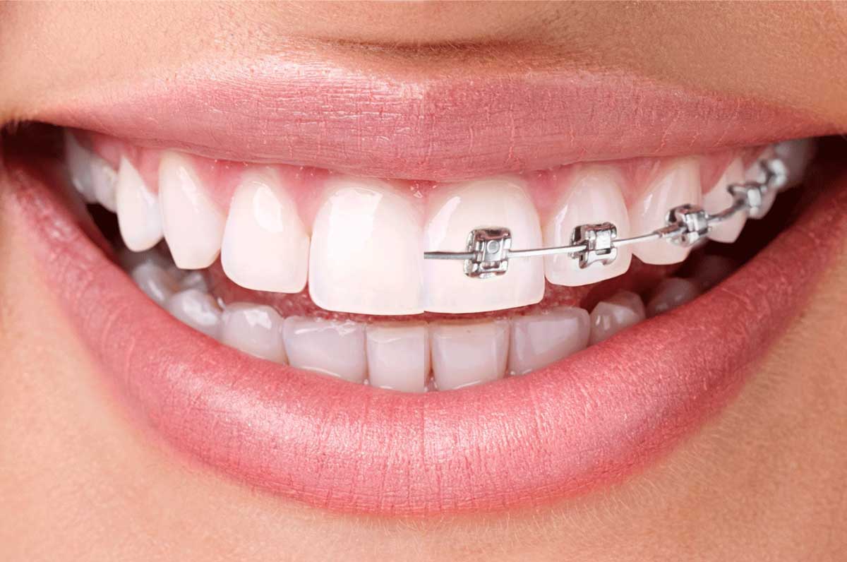 ข้อควรระวังระหว่างจัดฟัน – Bkk-Dental.Com